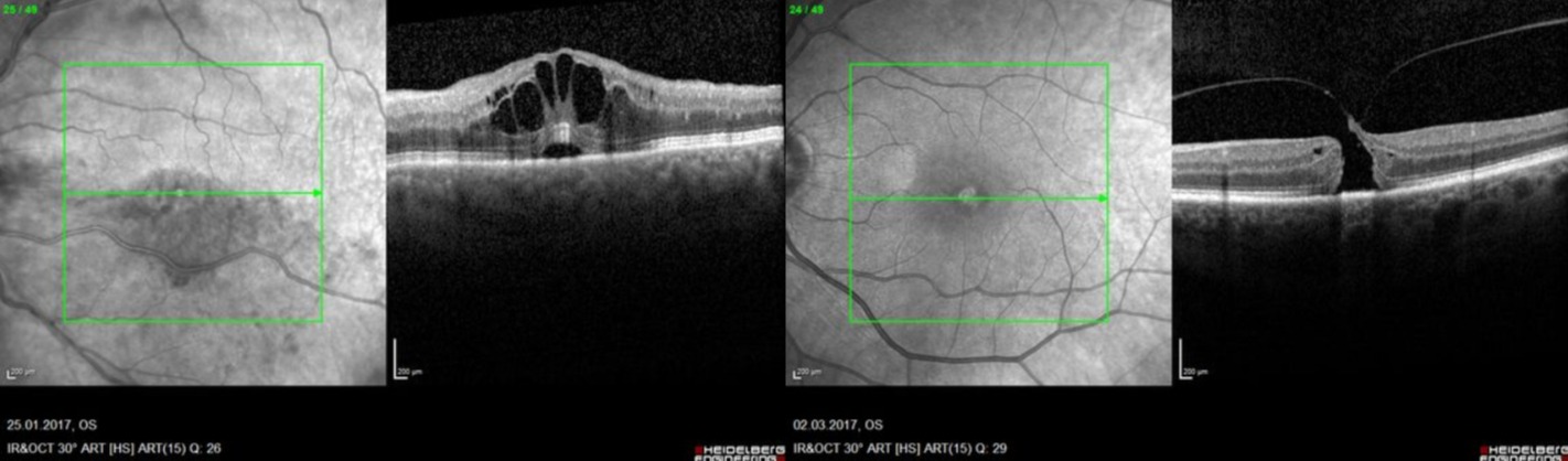 Die optische Kohärenztomographie in der Makuladiagnostik...