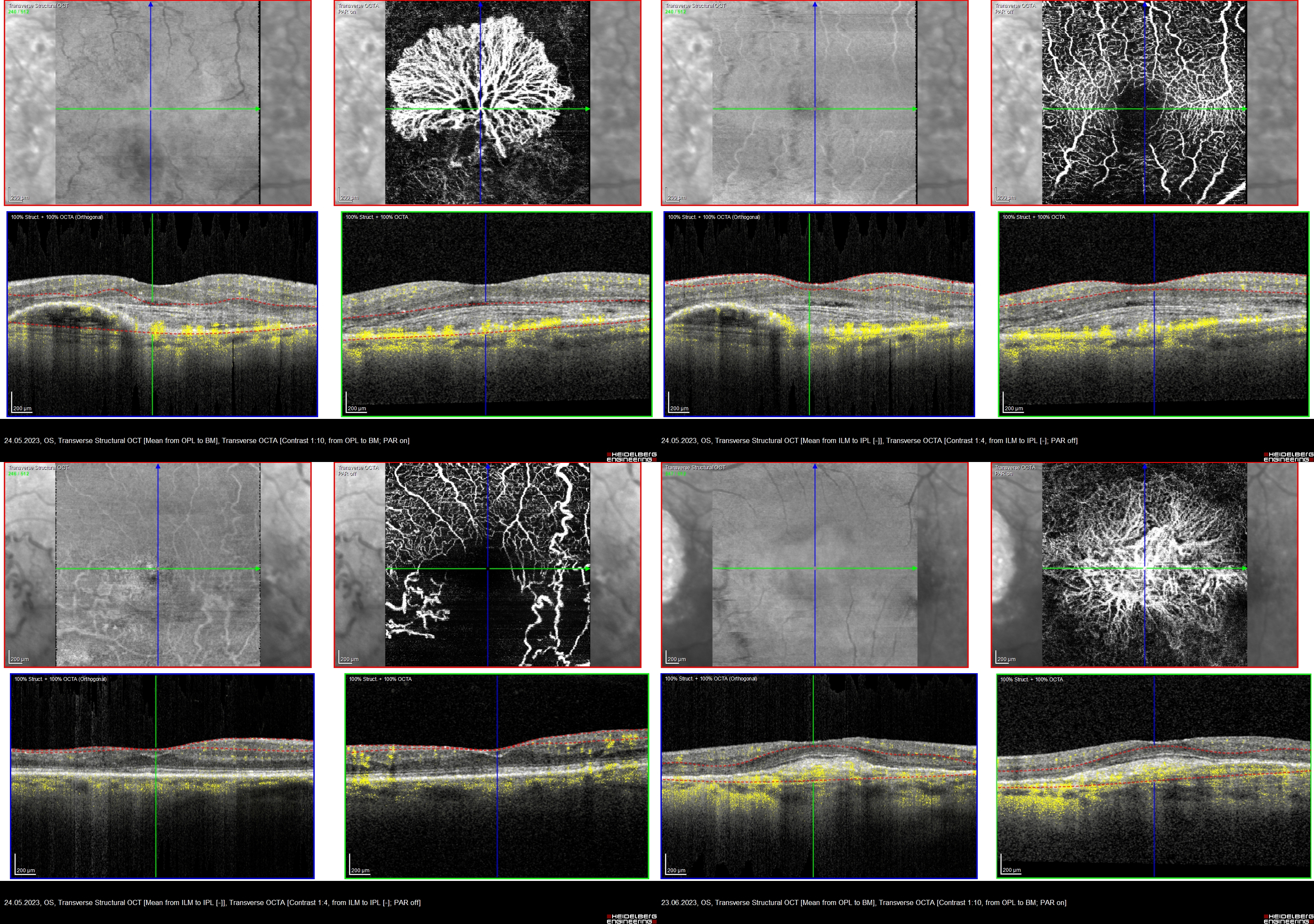 OCT-Angiographie